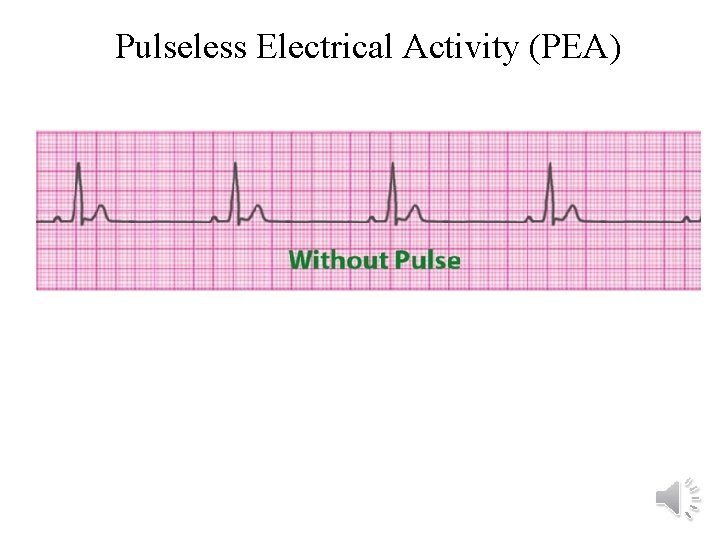 Pulseless Electrical Activity (PEA) 