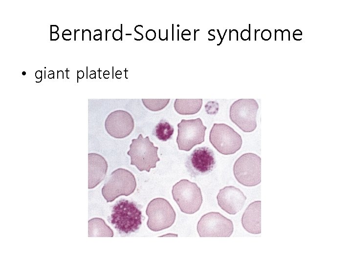 Bernard-Soulier syndrome • giant platelet 