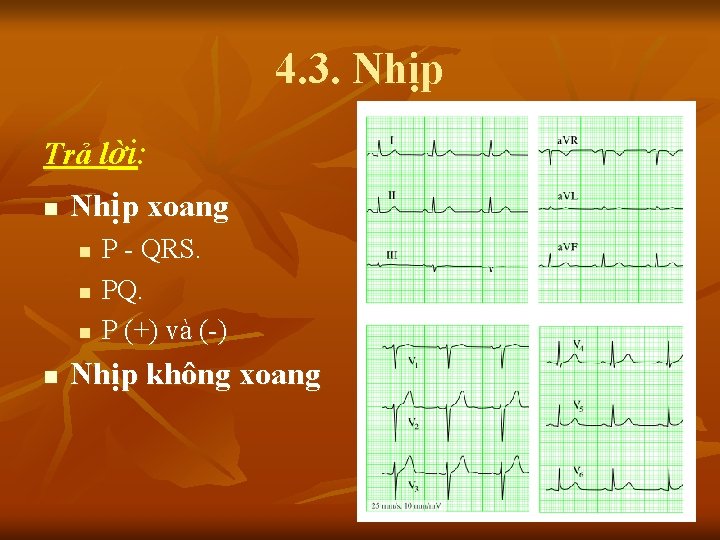 4. 3. Nhịp Trả lời: n Nhịp xoang n n P - QRS. PQ.