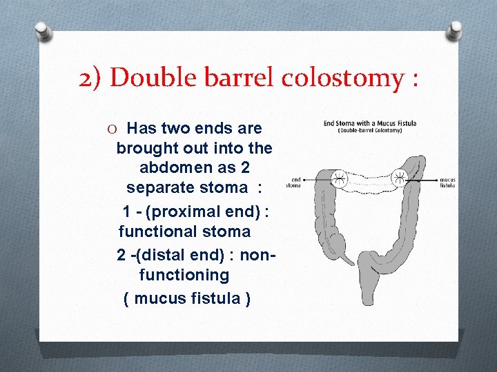 2) Double barrel colostomy : O Has two ends are brought out into the