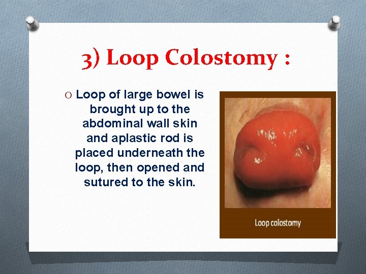 3) Loop Colostomy : O Loop of large bowel is brought up to the