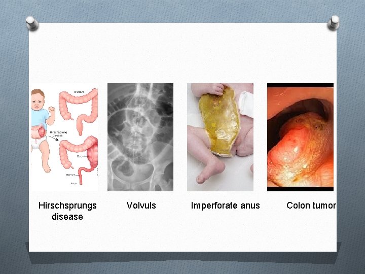 Hirschsprungs disease Volvuls Imperforate anus Colon tumor 