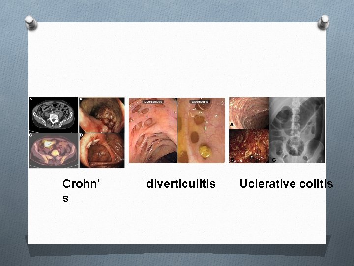 Crohn’ s diverticulitis Uclerative colitis 