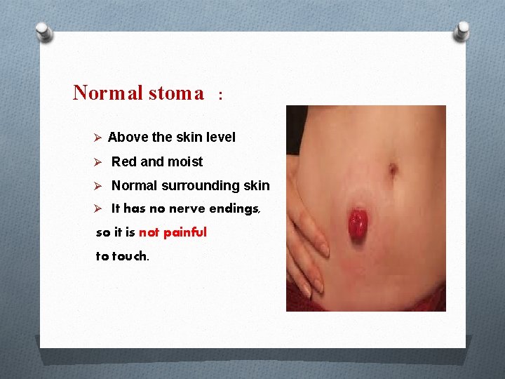 Normal stoma : Ø Above the skin level Ø Red and moist Ø Normal