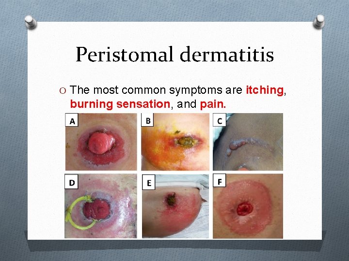Peristomal dermatitis O The most common symptoms are itching, burning sensation, and pain. 