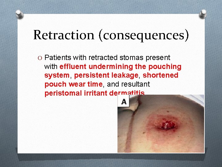 Retraction (consequences) O Patients with retracted stomas present with effluent undermining the pouching system,