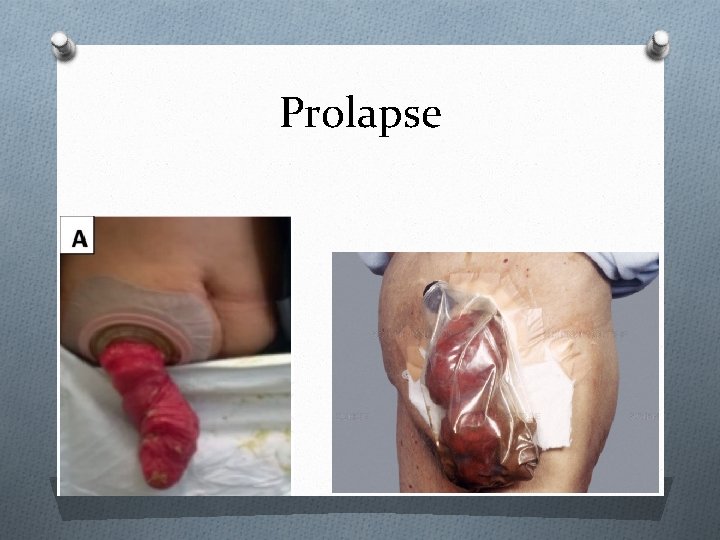 Prolapse 