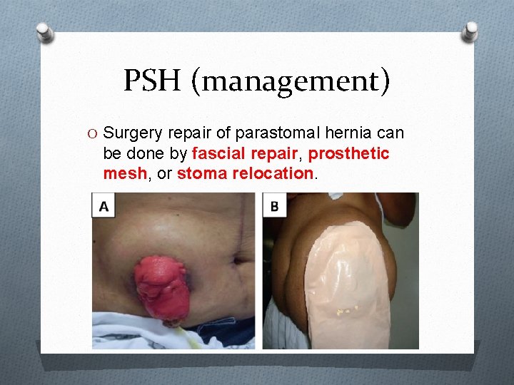 PSH (management) O Surgery repair of parastomal hernia can be done by fascial repair,