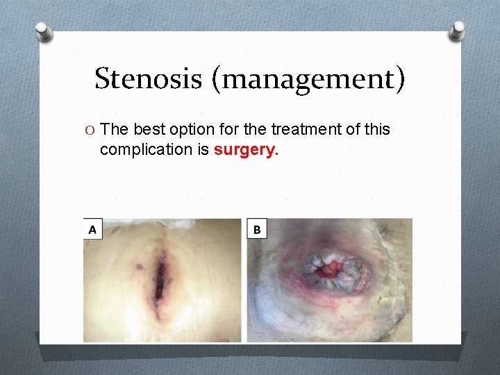 Stenosis (management) O The best option for the treatment of this complication is surgery.