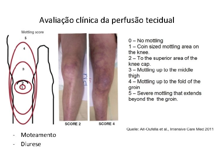 Avaliação clínica da perfusão tecidual • Em uma avaliação inicial do choque circulatório, a