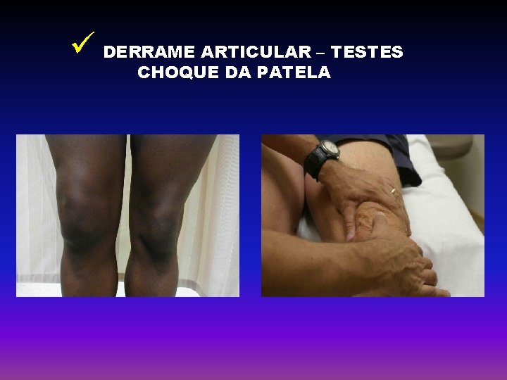 ü DERRAME ARTICULAR – TESTES CHOQUE DA PATELA 