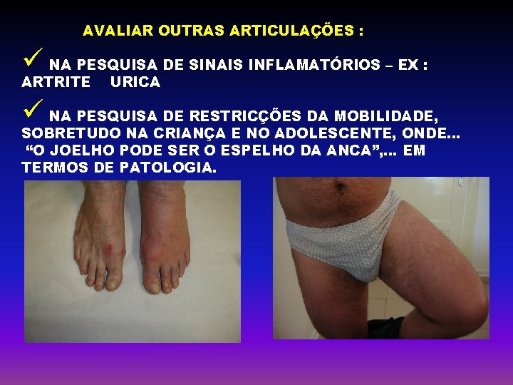 AVALIAR OUTRAS ARTICULAÇÕES : ü NA PESQUISA DE SINAIS INFLAMATÓRIOS – EX : ARTRITE