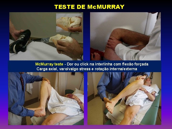 TESTE DE Mc. MURRAY Mc. Murray teste - Dor ou click na interlinha com