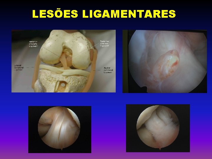 LESÕES LIGAMENTARES 