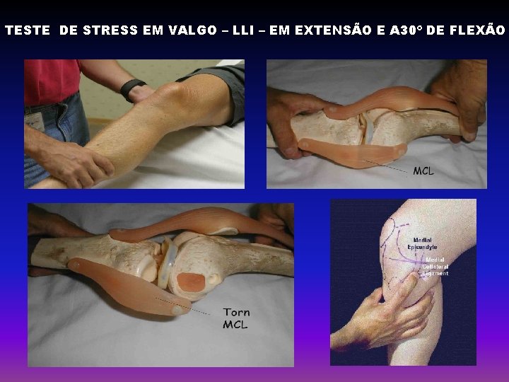 TESTE DE STRESS EM VALGO – LLI – EM EXTENSÃO E A 30º DE