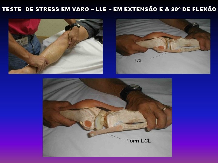 TESTE DE STRESS EM VARO – LLE – EM EXTENSÃO E A 30º DE