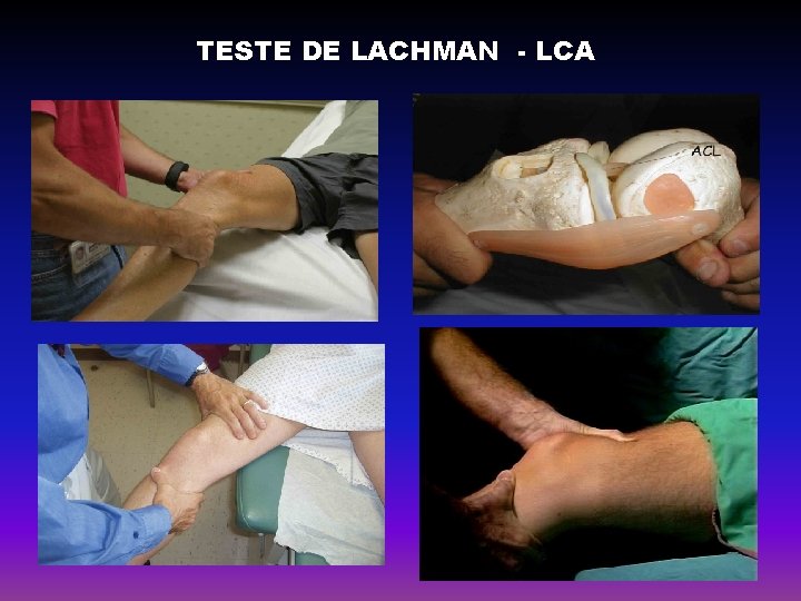 TESTE DE LACHMAN - LCA 