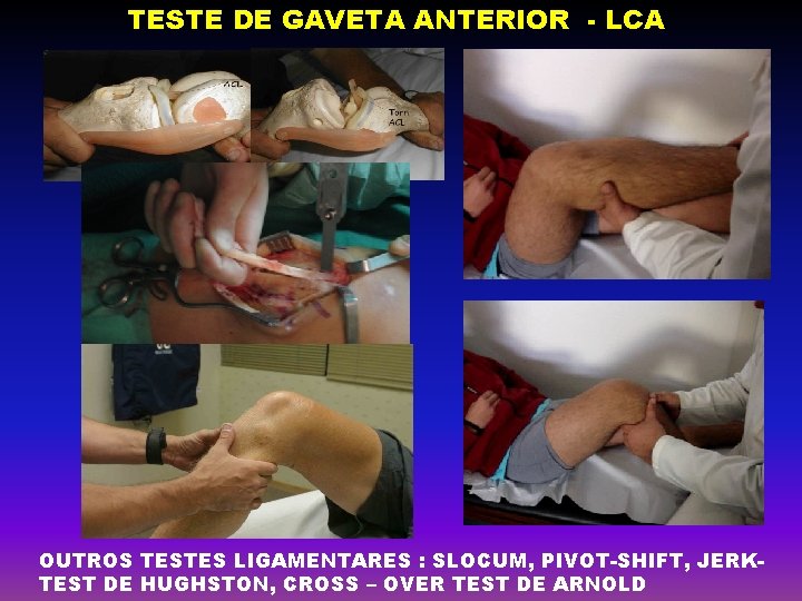 TESTE DE GAVETA ANTERIOR - LCA OUTROS TESTES LIGAMENTARES : SLOCUM, PIVOT-SHIFT, JERKTEST DE