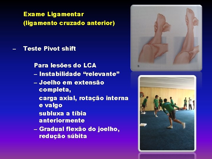 Exame Ligamentar (ligamento cruzado anterior) – Teste Pivot shift Para lesões do LCA –