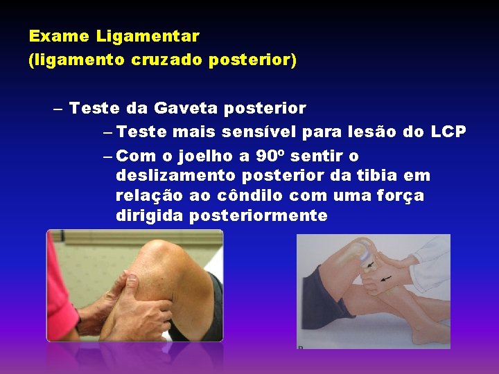 Exame Ligamentar (ligamento cruzado posterior) – Teste da Gaveta posterior – Teste mais sensível