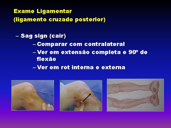 Exame Ligamentar (ligamento cruzado posterior) – Sag sign (cair) – Comparar com contralateral –