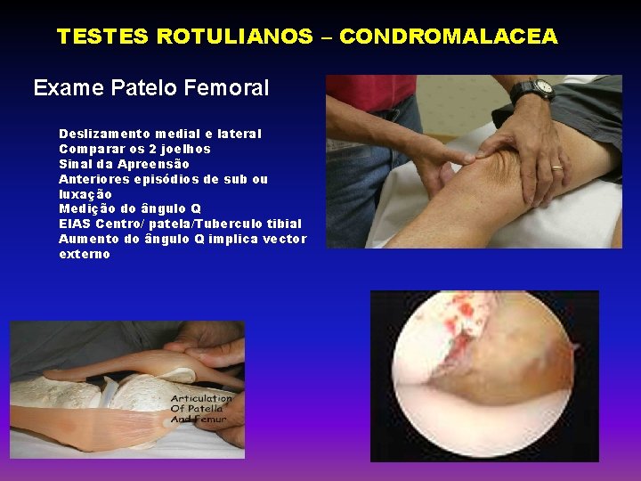 TESTES ROTULIANOS – CONDROMALACEA Exame Patelo Femoral Deslizamento medial e lateral Comparar os 2