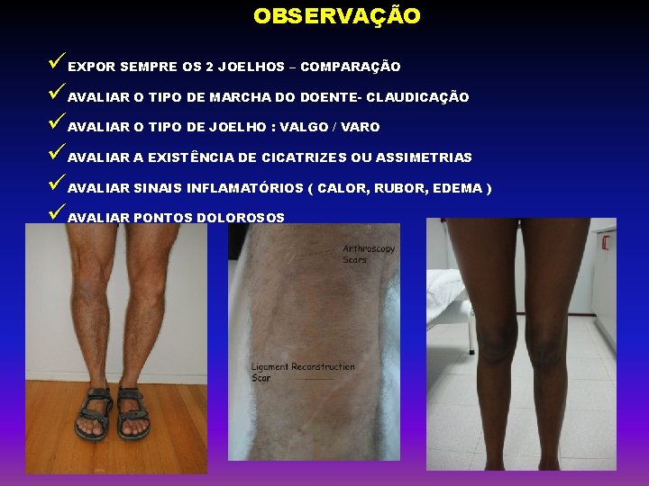 OBSERVAÇÃO üEXPOR SEMPRE OS 2 JOELHOS – COMPARAÇÃO üAVALIAR O TIPO DE MARCHA DO