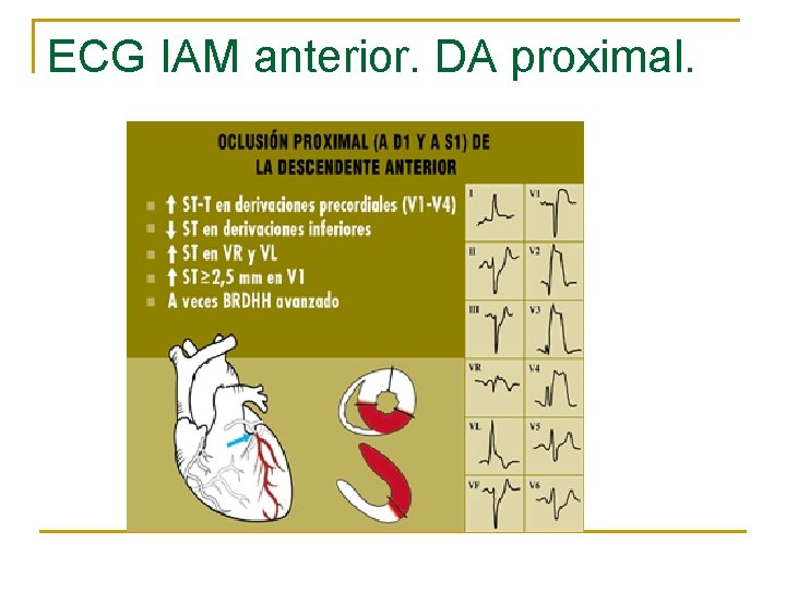 ECG IAM anterior. DA proximal. 