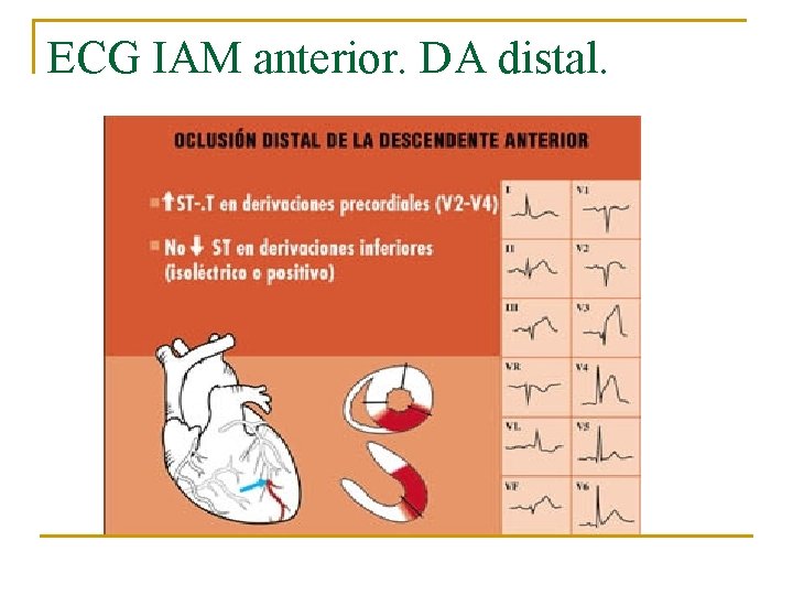 ECG IAM anterior. DA distal. 