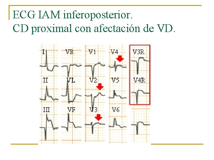 ECG IAM inferoposterior. CD proximal con afectación de VD. 