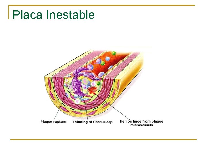 Placa Inestable 