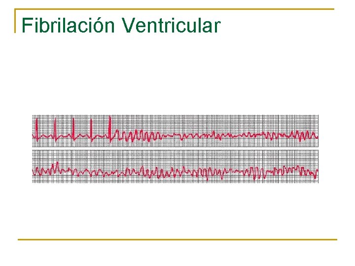 Fibrilación Ventricular 