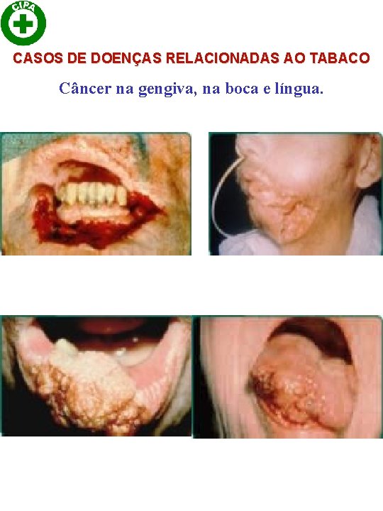 CASOS DE DOENÇAS RELACIONADAS AO TABACO Câncer na gengiva, na boca e língua. 