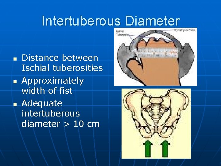 Intertuberous Diameter n n n Distance between Ischial tuberosities Approximately width of fist Adequate