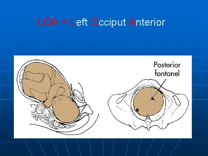 LOA = Left Occiput Anterior 