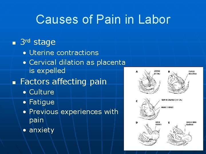 Causes of Pain in Labor n 3 rd stage • Uterine contractions • Cervical
