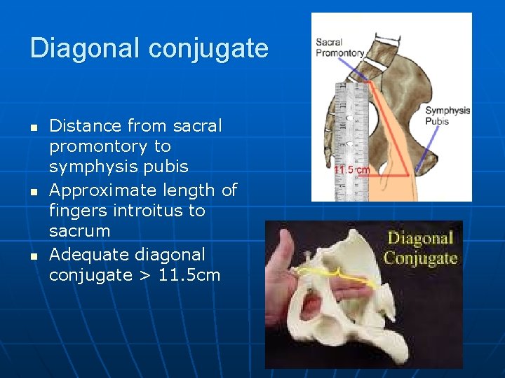 Diagonal conjugate n n n Distance from sacral promontory to symphysis pubis Approximate length