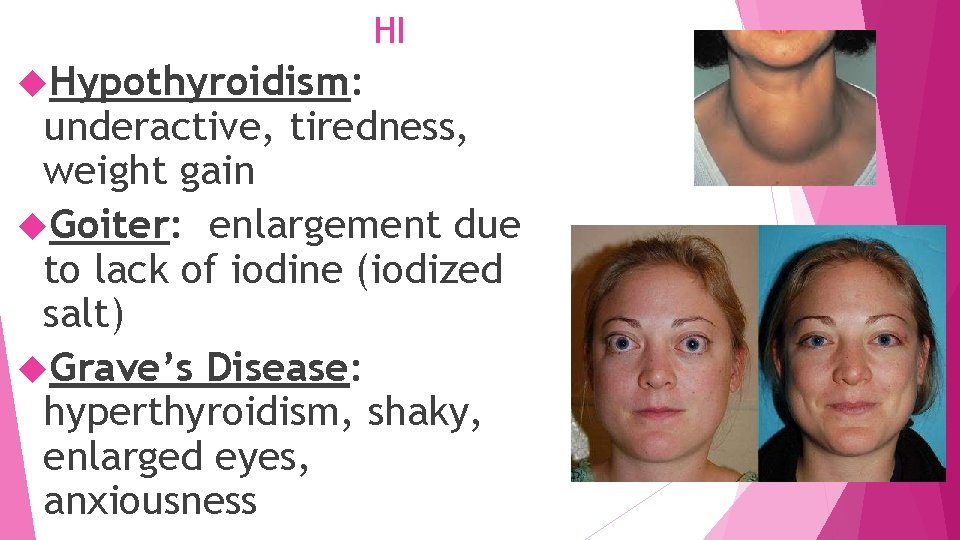HI Hypothyroidism: underactive, tiredness, weight gain Goiter: enlargement due to lack of iodine (iodized