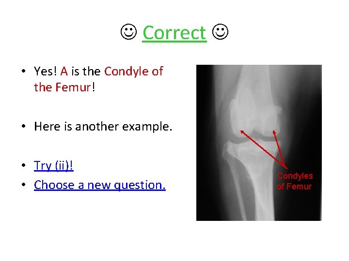  Correct • Yes! A is the Condyle of the Femur! • Here is