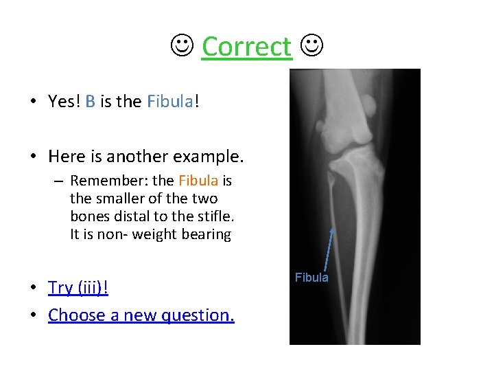  Correct • Yes! B is the Fibula! • Here is another example. –