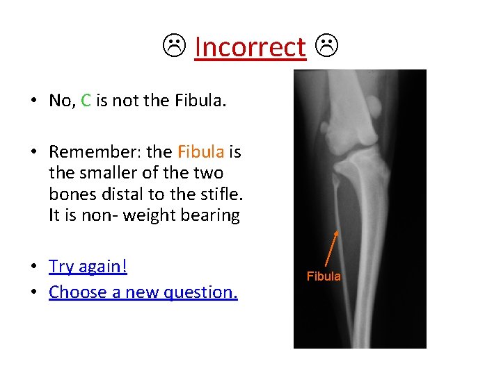  Incorrect • No, C is not the Fibula. • Remember: the Fibula is