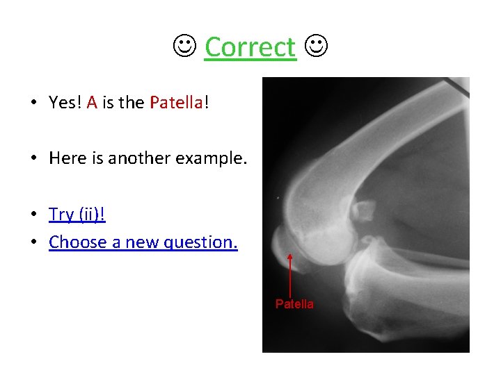  Correct • Yes! A is the Patella! • Here is another example. •