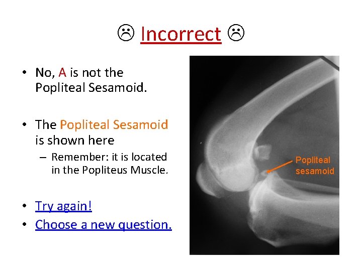  Incorrect • No, A is not the Popliteal Sesamoid. • The Popliteal Sesamoid