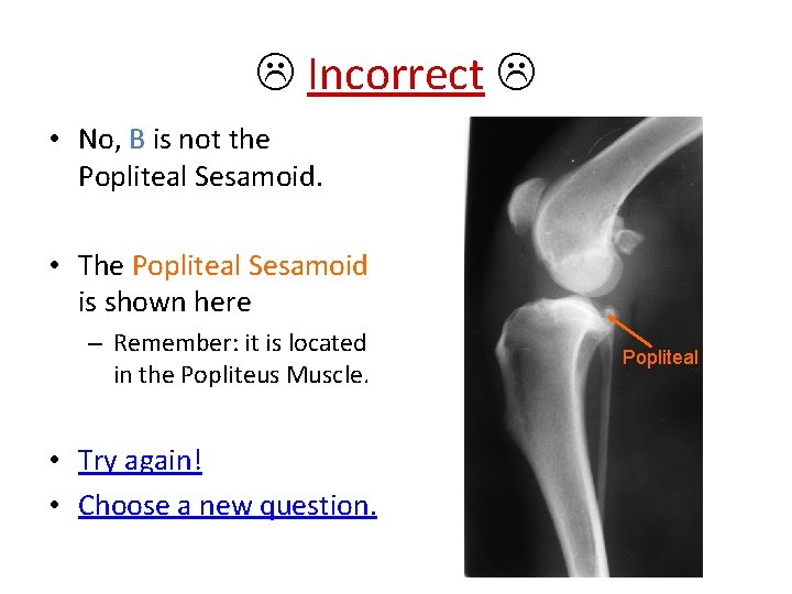  Incorrect • No, B is not the Popliteal Sesamoid. • The Popliteal Sesamoid