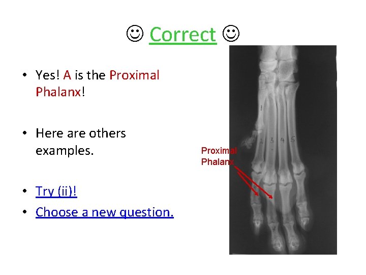  Correct • Yes! A is the Proximal Phalanx! • Here are others examples.