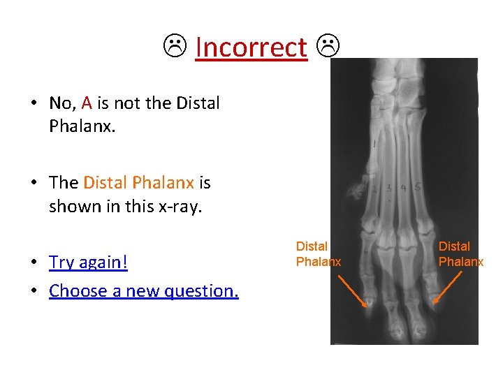  Incorrect • No, A is not the Distal Phalanx. • The Distal Phalanx