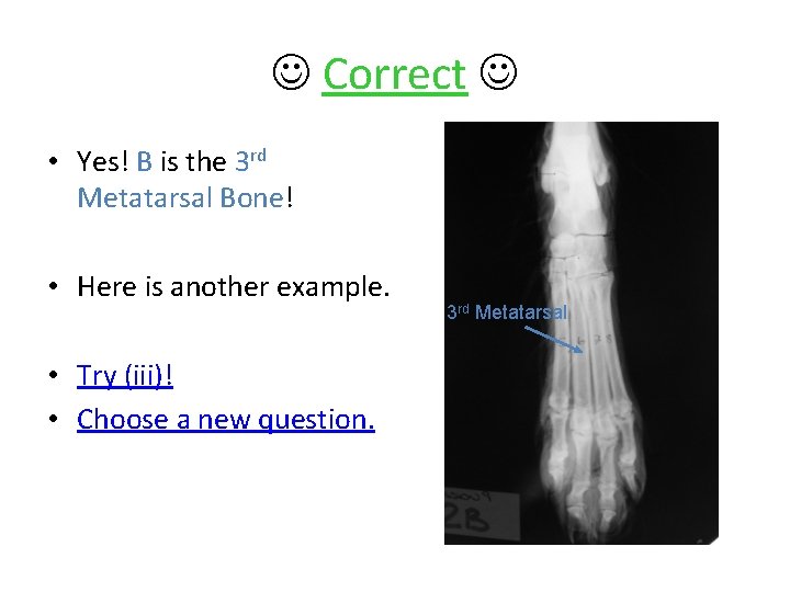  Correct • Yes! B is the 3 rd Metatarsal Bone! • Here is