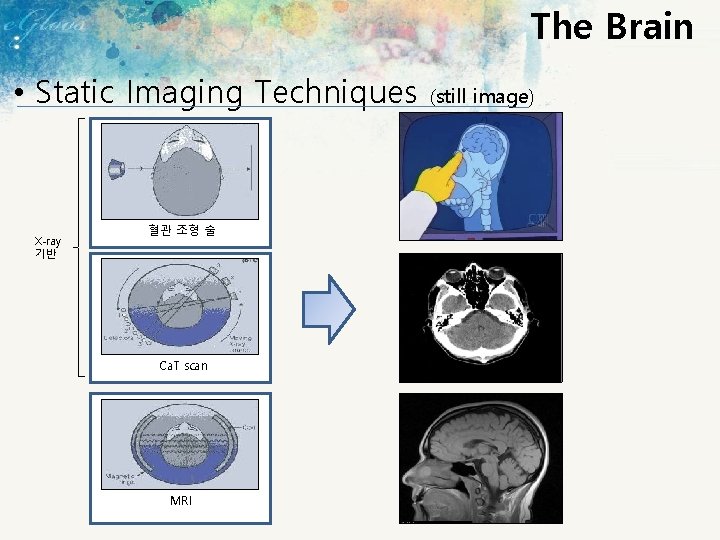 The Brain • Static Imaging Techniques X-ray 기반 혈관 조형 술 Ca. T scan