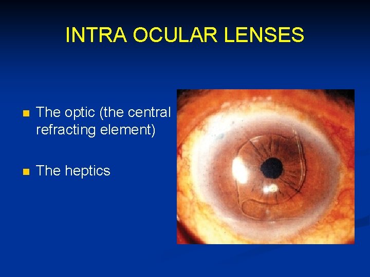 INTRA OCULAR LENSES n The optic (the central refracting element) n The heptics 