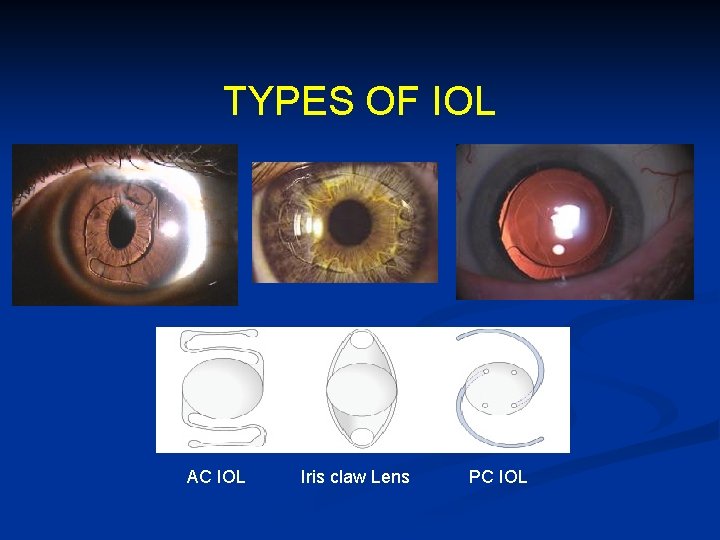 TYPES OF IOL AC IOL Iris claw Lens PC IOL 